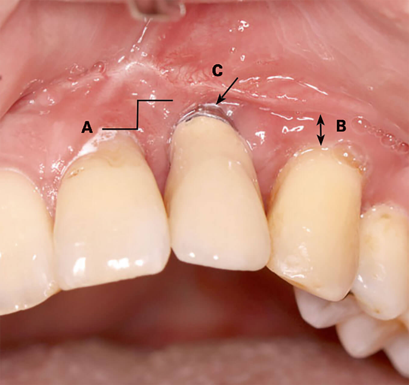 Abb. 8 Beachtenswert bei der Mundhygiene am Implantat: horizontaler Versatz zu den Nachbarzähnen (A), mangelnde Breite der befestigten Mukosa (B), freiliegendes Abutment beziehungsweise freiliegende Implantatoberflächenstrukturen (C).