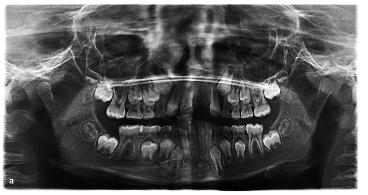Abb. 1a Ausgangssituation des damals 9-jährigen Patienten nach Avulsion und Verlust des Zahns 21.