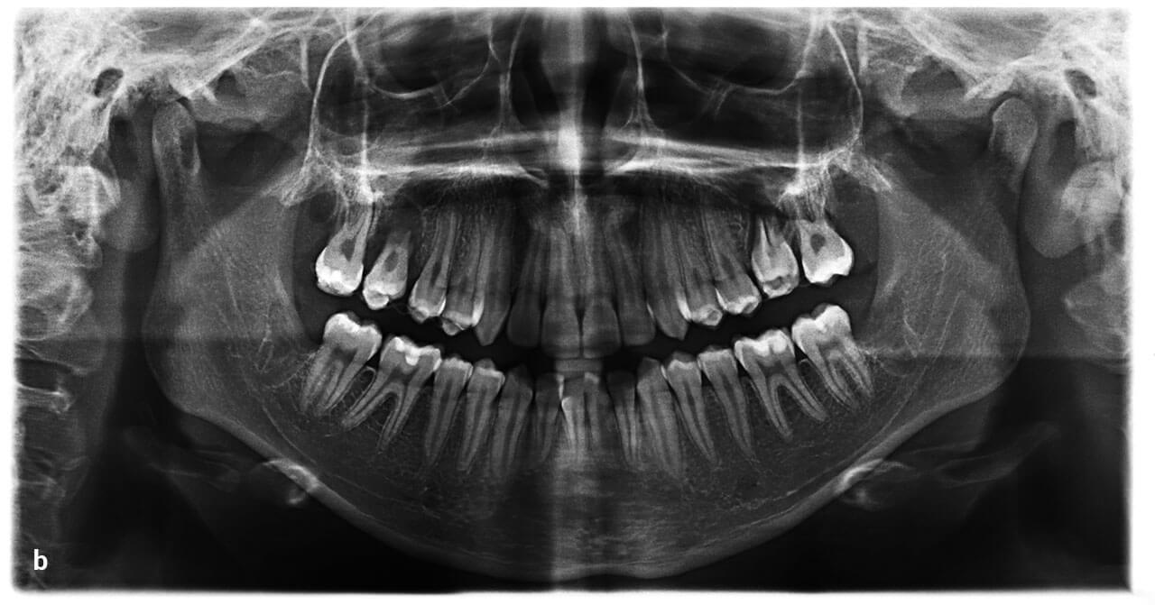 Abb. 2b Postoperativer Situs nach Entfernung der Zähne 16, 26, 38 sowie 48 und Transplantation der Weisheitszähne 18 und 28 auf Position 16 und 26 mit Schienung in situ.