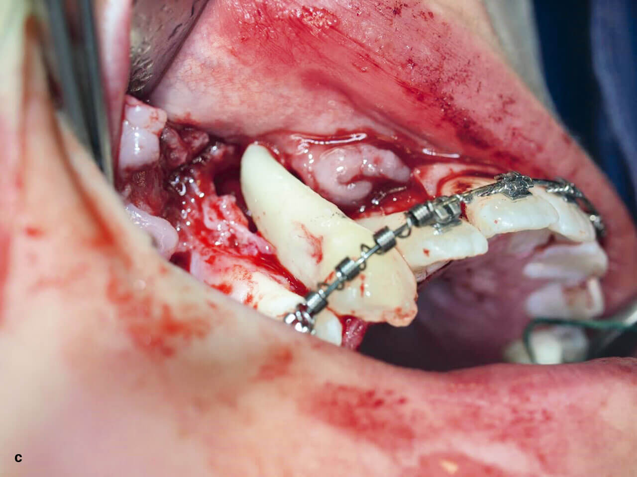 Abb. 4c Einprobe des Zahns 13 in die Neoalveole.