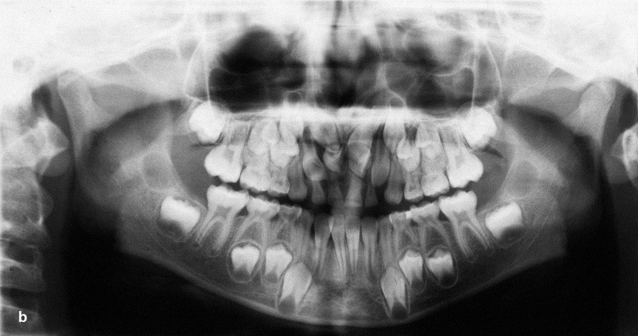 Abb. 1a bis b Patient mit Behinderung des Frontzahndurchbruches durch zusätzliche Zahnanlagen: Der Patient stellte sich mit einem erheblichen Leidensdruck aufgrund der ästhetisch-funktionellen Situation vor.