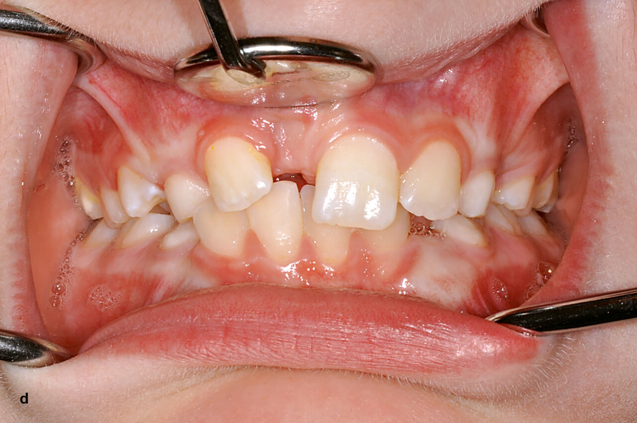 Abb. 1c bis d Einengung der Lücke für den Zahn 11 durch Aufwanderung und Kippung der Nachbarzähne bei Durchbruchsstörung in der Folge eines Traumas im Milchgebiss.