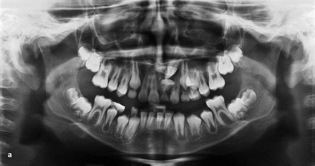 Abb. 2 a Verschiedene Beispiele von Durchbruchsstörungen des Zahnes 21 durch einen Mesiodens. Darstellung der Durchbruchsstörung im Orthopantomogramm (OPG).