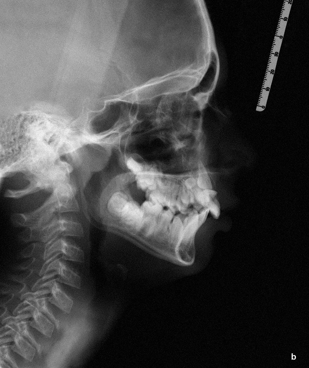 Abb. 2 b In einigen Fällen kann auch das Fernröntgen­seitenbild (FRS) bei der Beurteilung von Form und Lage des Zahnes hilfreich sein.