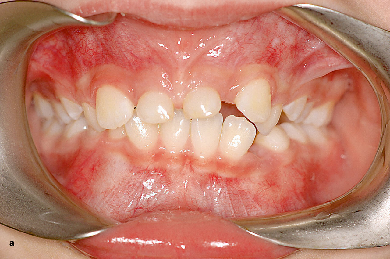 Abb. 3 a und b Patient mit Durchbruchsstörungen an den Zähnen 11 und 21 durch paarige Mesiodentes mit tuberkulärer Morphologie (klinisches Bild).