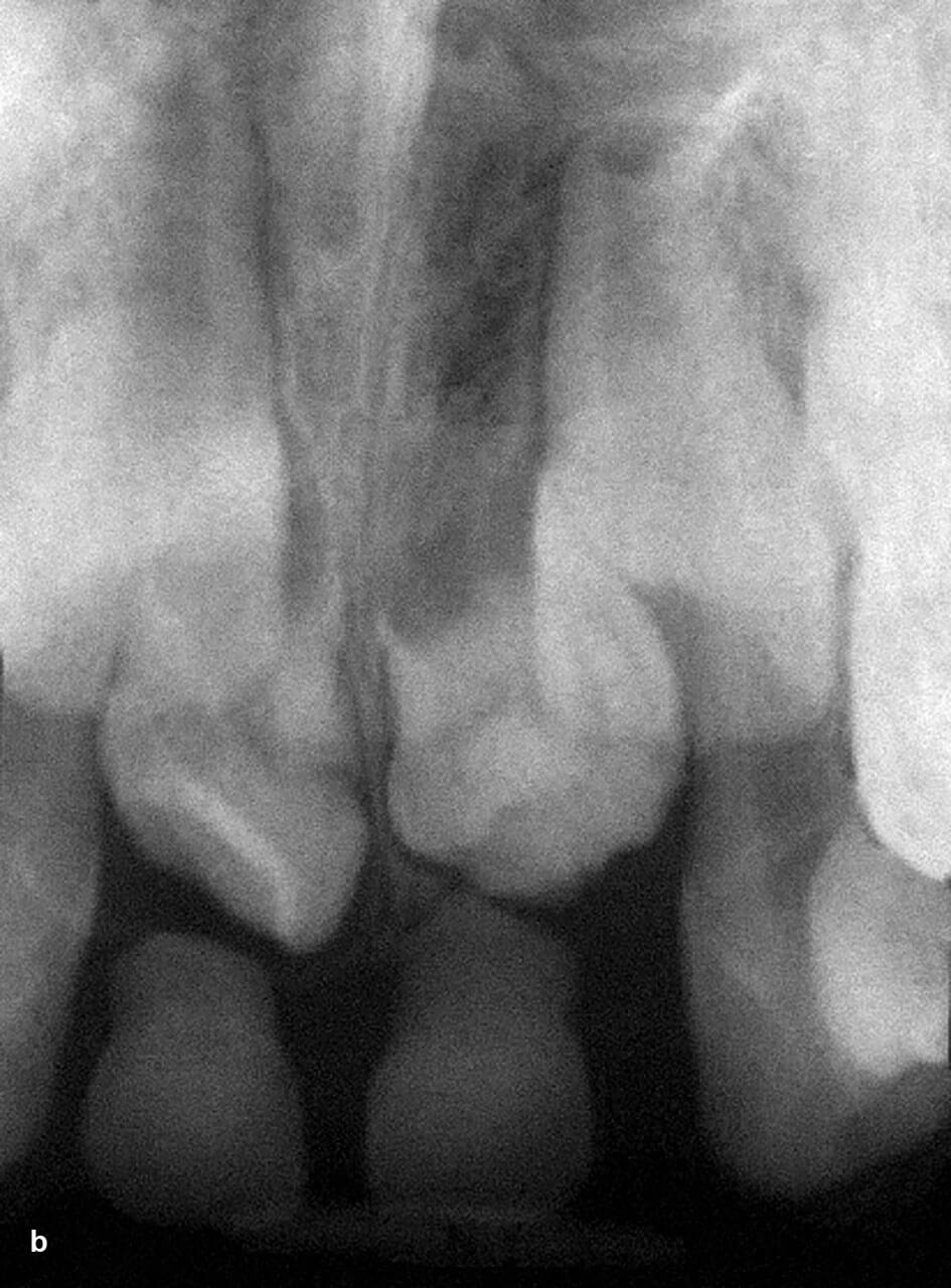 Abb. 3 a und b Patient mit Durchbruchsstörungen an den Zähnen 11 und 21 durch paarige Mesiodentes mit tuberkulärer Morphologie (Zahnfilm).