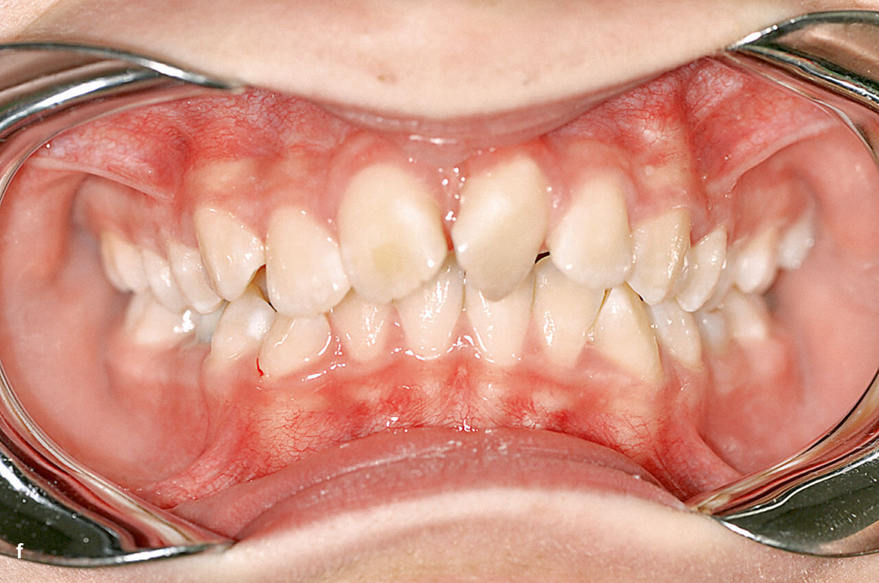 Abb. 3 f Befund nach Abschluss der ersten Behandlungsphase. Im Anschluss an den Zahnwechsel stehen jedoch noch weitere therapeutische Aufgaben an.