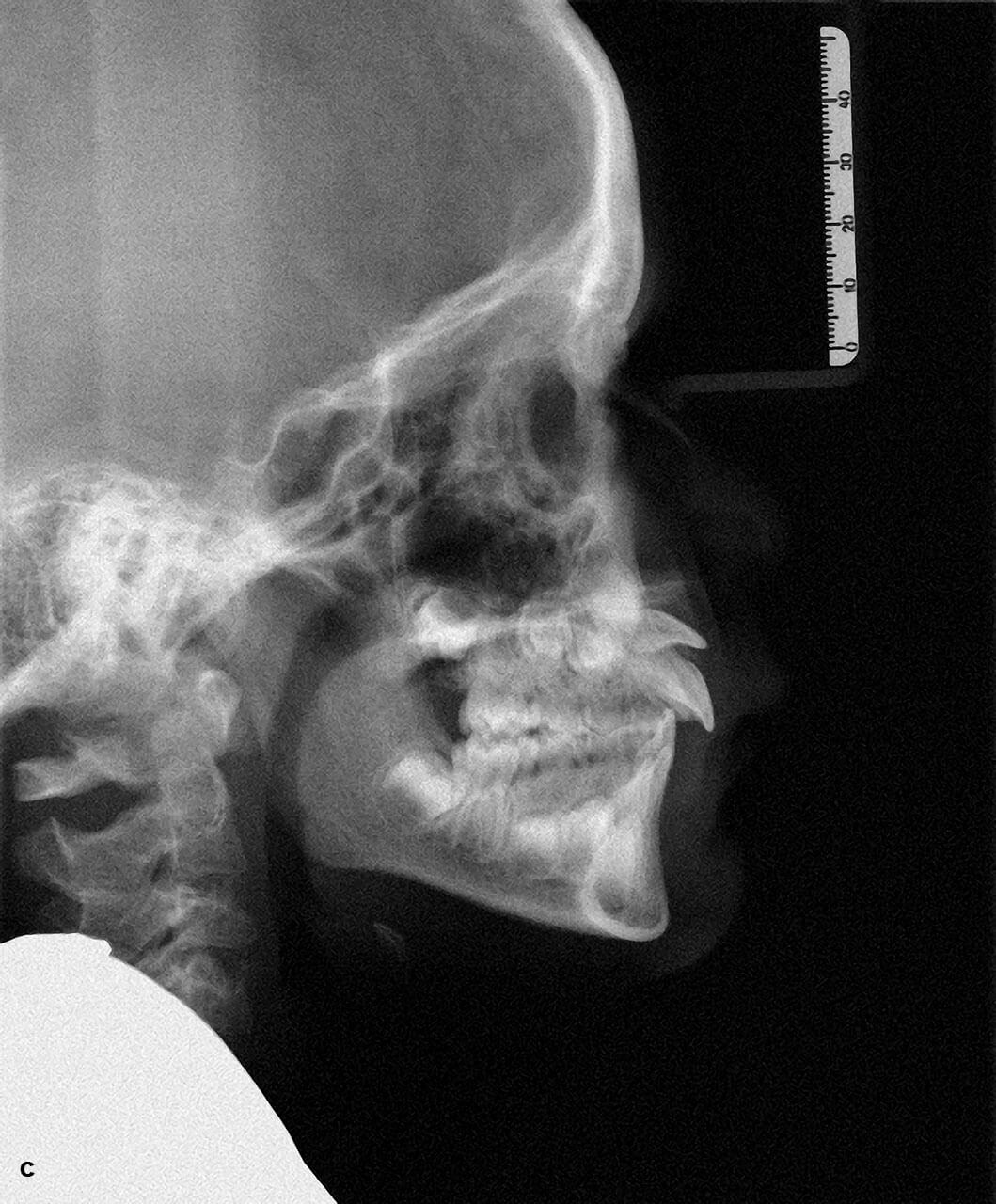 Abb. 5a bis c Ausgangssituation bei einem Patienten mit Durchbruchsstörung an Zahn 21 nach Milchzahntrauma, 
klinisches Bild (a), OPG (b), FRS (c).