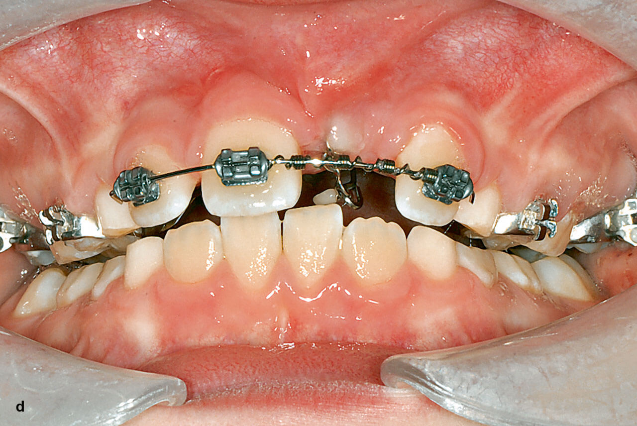 Abb. 5 d Nach Ausbleiben eines spontanen Zahndurchbruches erfolgte die aktive Einord-nung (d, e). Bei der Freilegung wurde zur Korrektur der Achsneigung das Attachment palatinal geklebt. Parallel wurde kieferorthopädisch die Lücke geöffnet.
