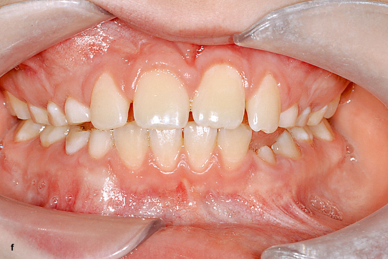 Abb. 5 e und f Befund nach Lösung der ersten Behandlungs­aufgabe (f) und OPG (g). Nach fortgeschrittenem Zahnwechsel stehen weitere Behandlungsaufgaben an.