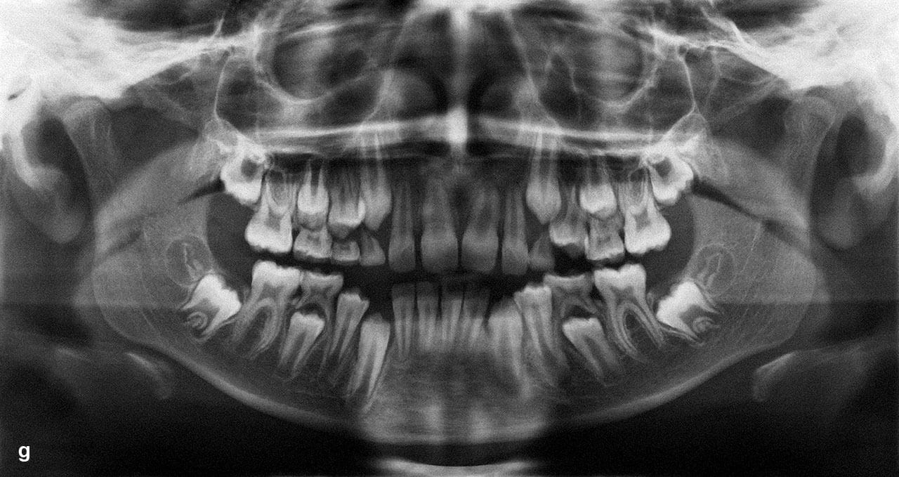 Abb. 5 f und g Befund nach Lösung der ersten Behandlungs­aufgabe (f) und OPG (g). Nach fortgeschrittenem Zahnwechsel stehen weitere Behandlungsaufgaben an.