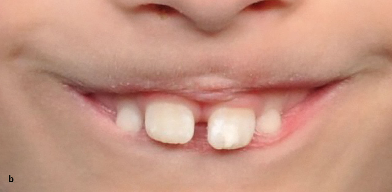 Abb. 4b Extraorale Fotos eines jungen Patienten mit potenziell kompetentem Lippenschluss aufgrund einer vergrößerten sagittalen Frontzahnstufe: Lachaufnahme.