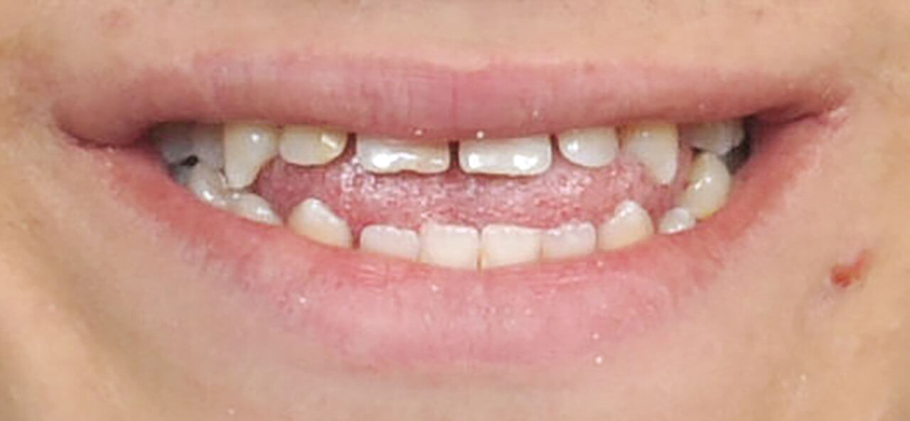 Abb. 8 Lachaufnahme eines erwachsenen Patienten mit einem frontal offenen Biss aufgrund einer starken Zungenfehlfunktion.