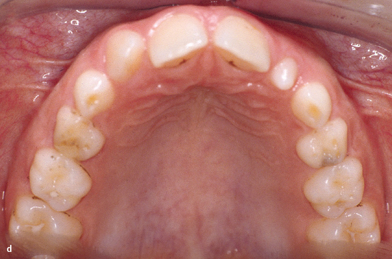 Abb. 2 d OK-Aufsichtsaufnahme: Der bleibende Zahn 13 ist anstelle des fehlenden Zahns 12 durchgebrochen mit Persistenz des Zahns 53 distal von 13.