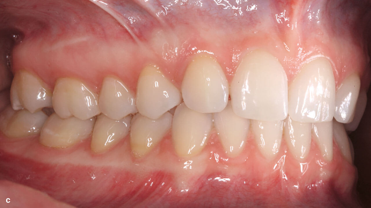 Abb. 3 c Entsprechend der mesialen Einstellung der OK-Seitenzähne ist die sagittale Verzahnung annähernd 1 Pb distal. Die OK- und UK-Inzisivi sind vertikal abgestützt.