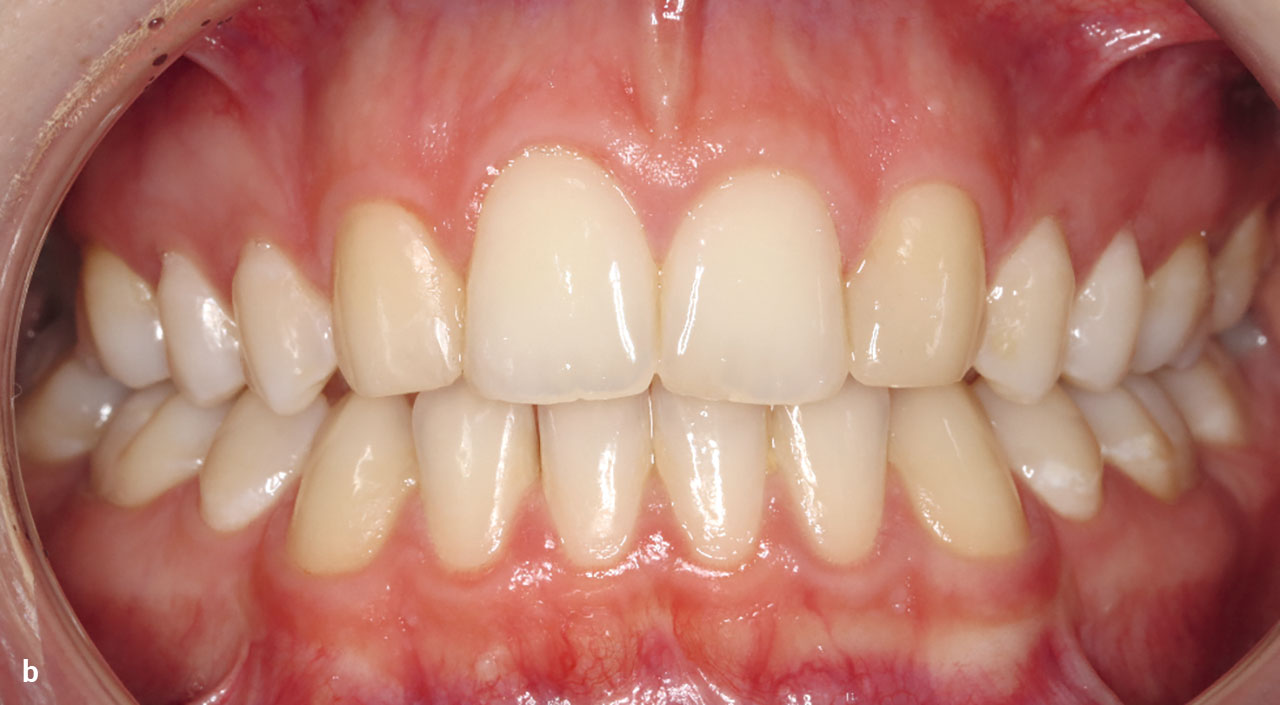 Abb. 9 b Die frontale dentale Ansicht zeigt einen weitgehend harmonischen Gingivaverlauf mit einer leichten Gingivarezession im Bereich des Zahns 11.