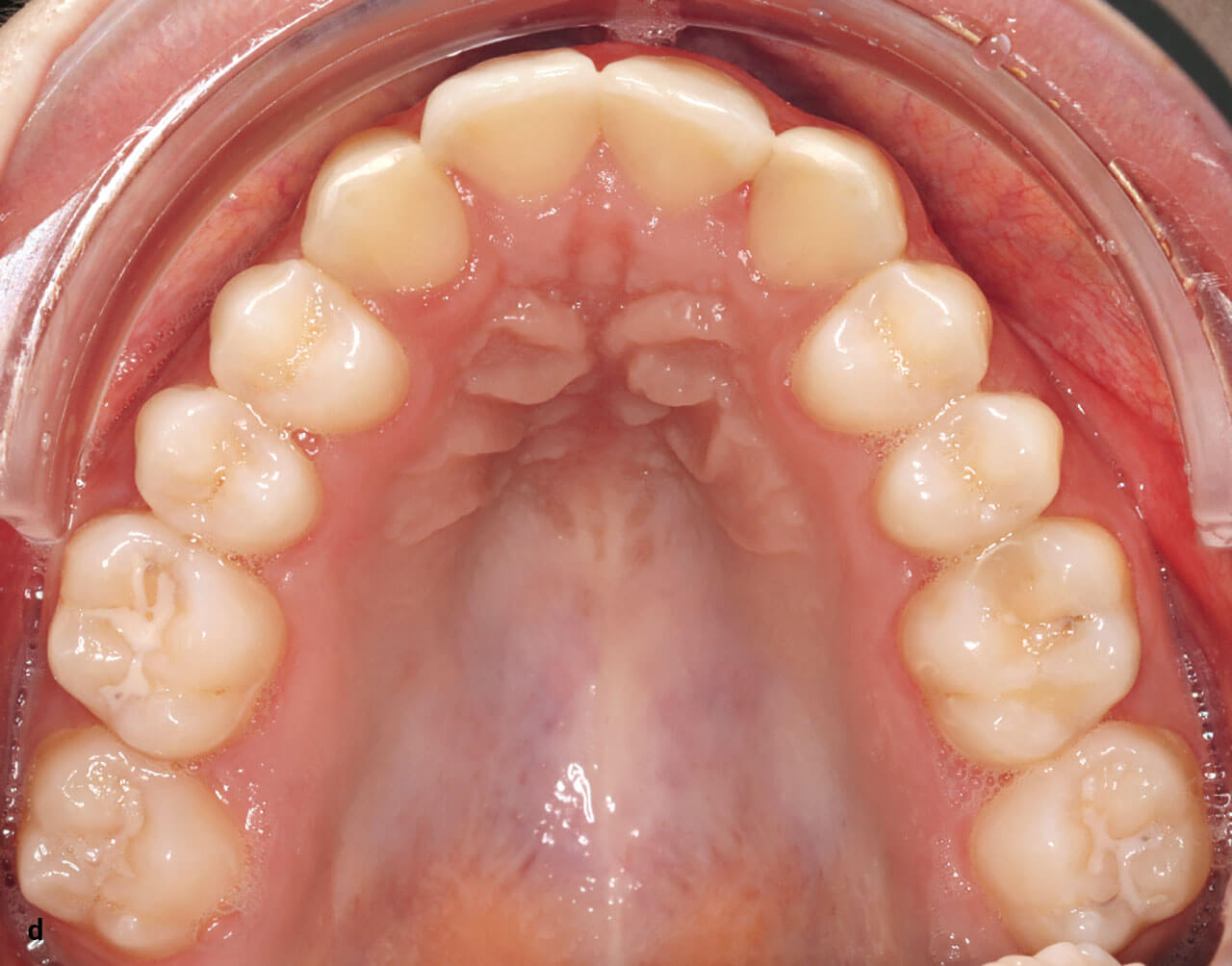 Abb. 9 d Aufsicht auf den ausgeformten OK-Zahnbogen ohne interdentale Lücken.
