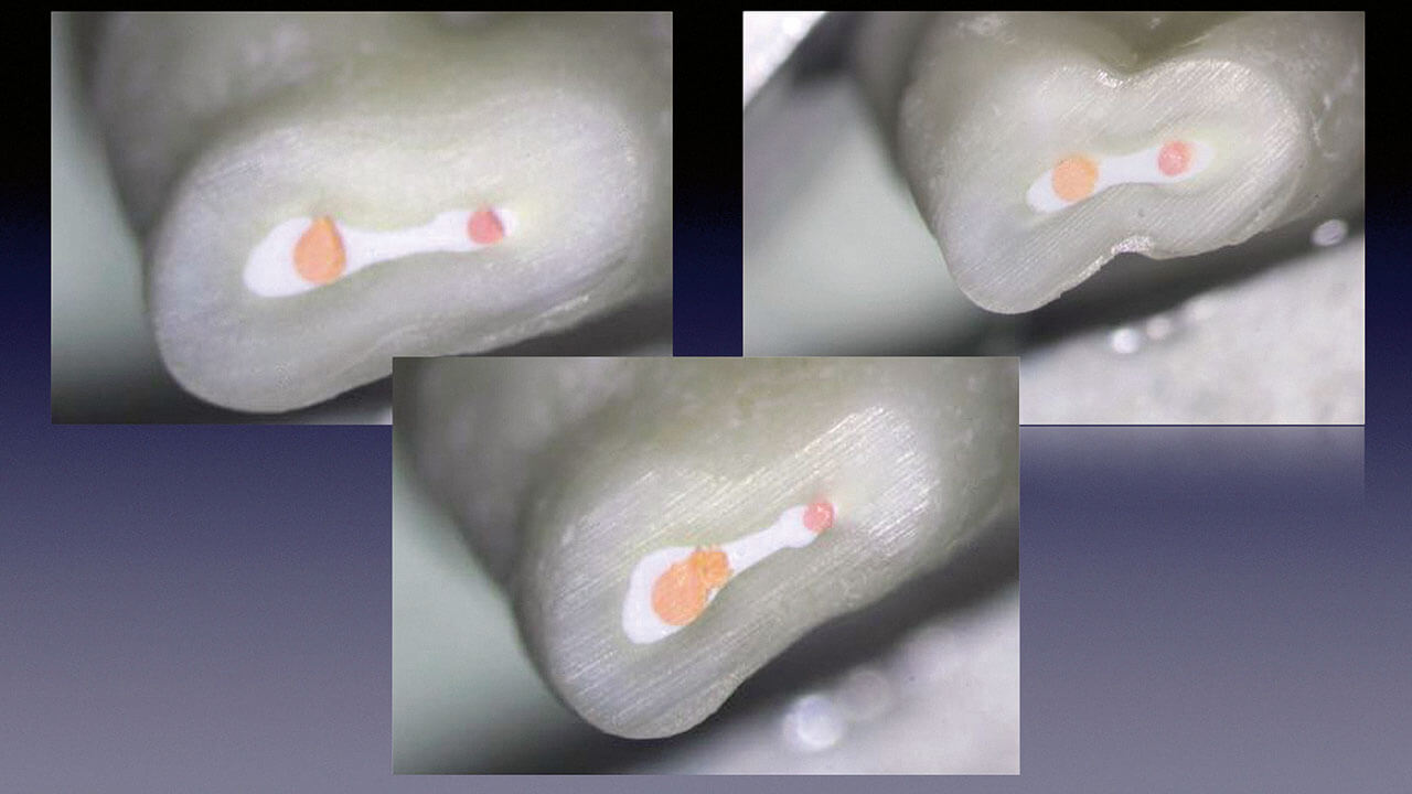 Abb. 1 Homogene blasenfreie Wurzelkanalfüllung bei einem Zahn mit sehr ovalem Kanallumen mit TotalFill BC Sealer (Fa. FKG Dentaire SA, La Chaux-de-Fonds, Schweiz).