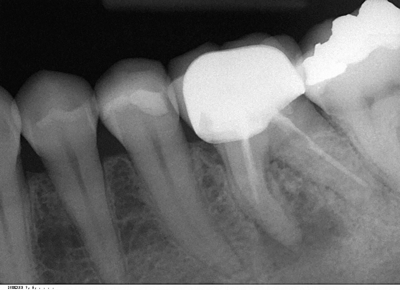 Abb. 2 Zahn 36 mit insuffizienter Wurzelkanalfüllung und apikaler Läsion.