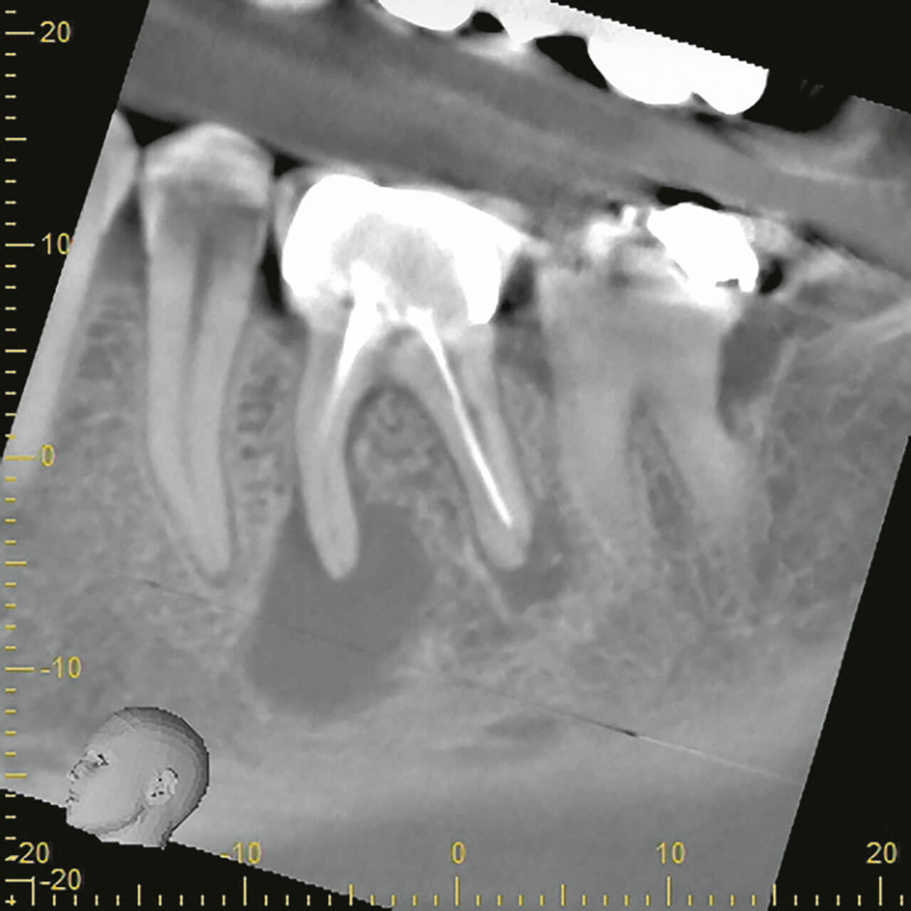 Abb. 3 Sagittale Schnittebene der digitalen Volumentomografie (DVT)-Aufnahme zeigt die Größe der apikalen  Läsion des Zahnes 36 an der mesialen Wurzel.