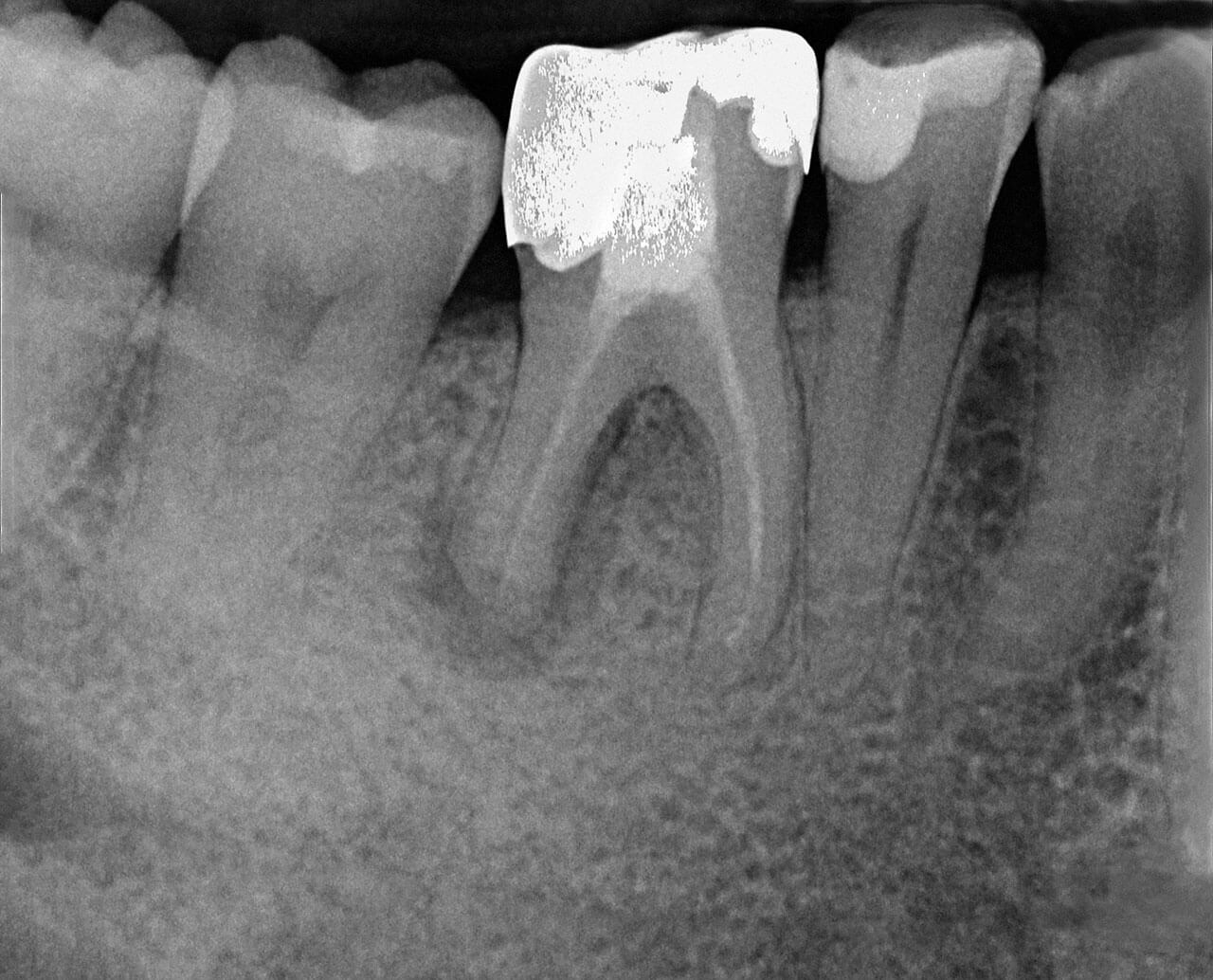 Abb. 7 Zahn 46 mit insuffizienter Wurzelkanalfüllung, apikaler Läsion und Resorption der distalen Wurzel.