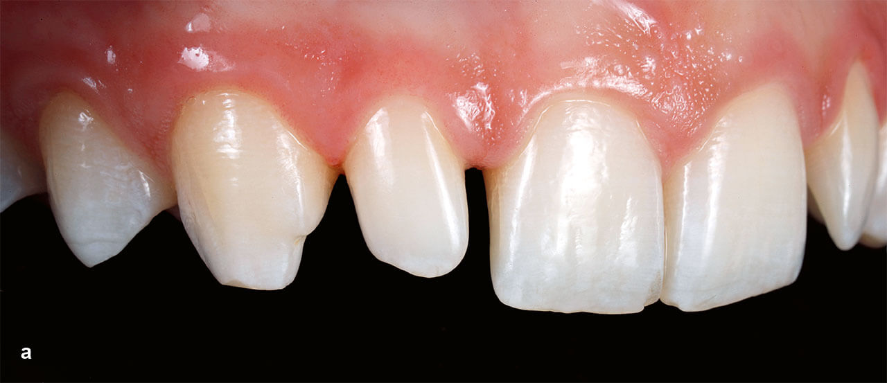 Abb. 1a bis c Minimalinvasive Präparation des lateralen Schnei­dezahns (Mikrodontie) und der distalen Fläche des Zahns 11 sowie der mesialen Fläche des Zahns 13 für die Aufnahme von partiellen Veneers (a).
