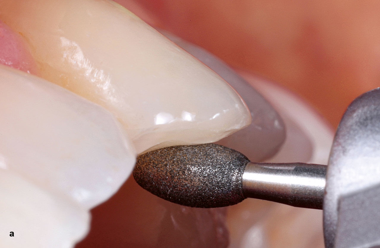 Abb. 2a und b Präparation für die Aufnahme eines palatinalen Teil-Veneers zur Rekonstruktion der Eckzahnführung an Zahn 23 (a).