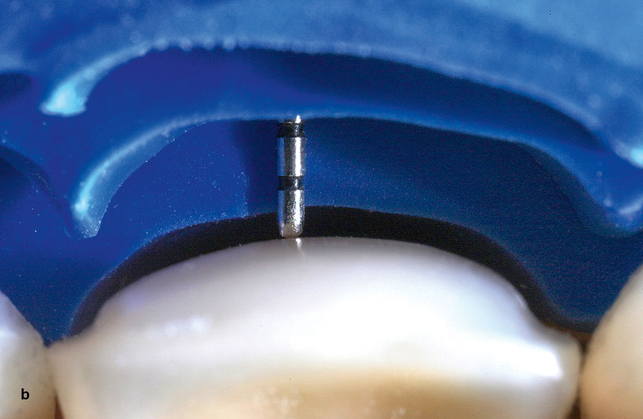 Abb. 3b Ein vom Wax-up abgeleiteter, in mehreren Ebenen beschnittener Silikonindex erleichtert die stetige Kontrolle des Abtrags in mehreren Ebenen mithilfe eines Parodontometers (b).
