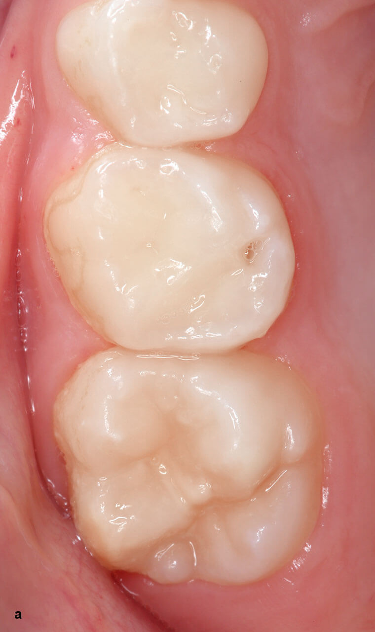Abb. 2a und b Größenunterschied zwischen Milchzähnen und bleibenden Zähnen: Milchmolaren und erste bleibende Mola­ren (a) sowie Inzisivi (b).