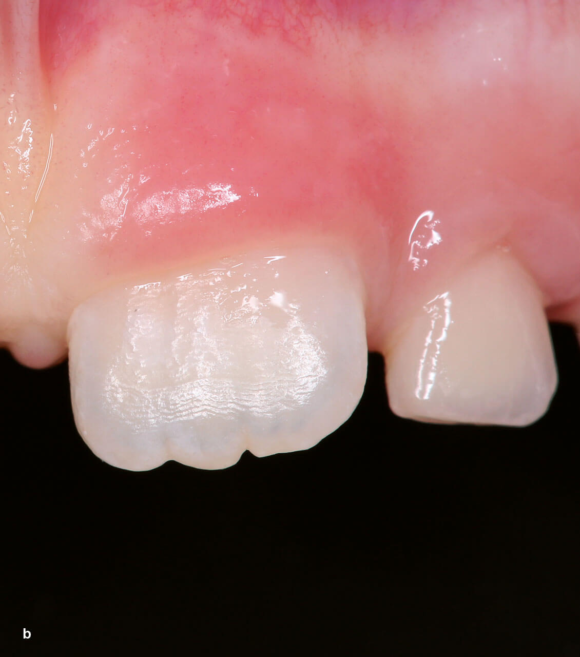 Abb. 2a und b Größenunterschied zwischen Milchzähnen und bleibenden Zähnen: Milchmolaren und erste bleibende Mola­ren (a) sowie Inzisivi (b).