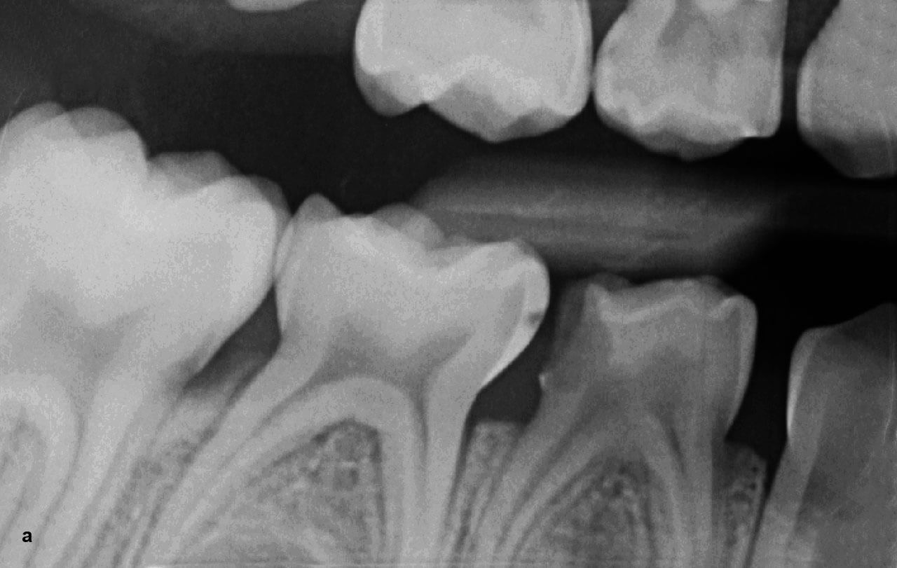 Abb. 3a Vitalamputation am Zahn 84, durchgeführt von Sarra Boukhobza, Universitätszahnklinik Wien: röntgenologische Ausgangssituation.