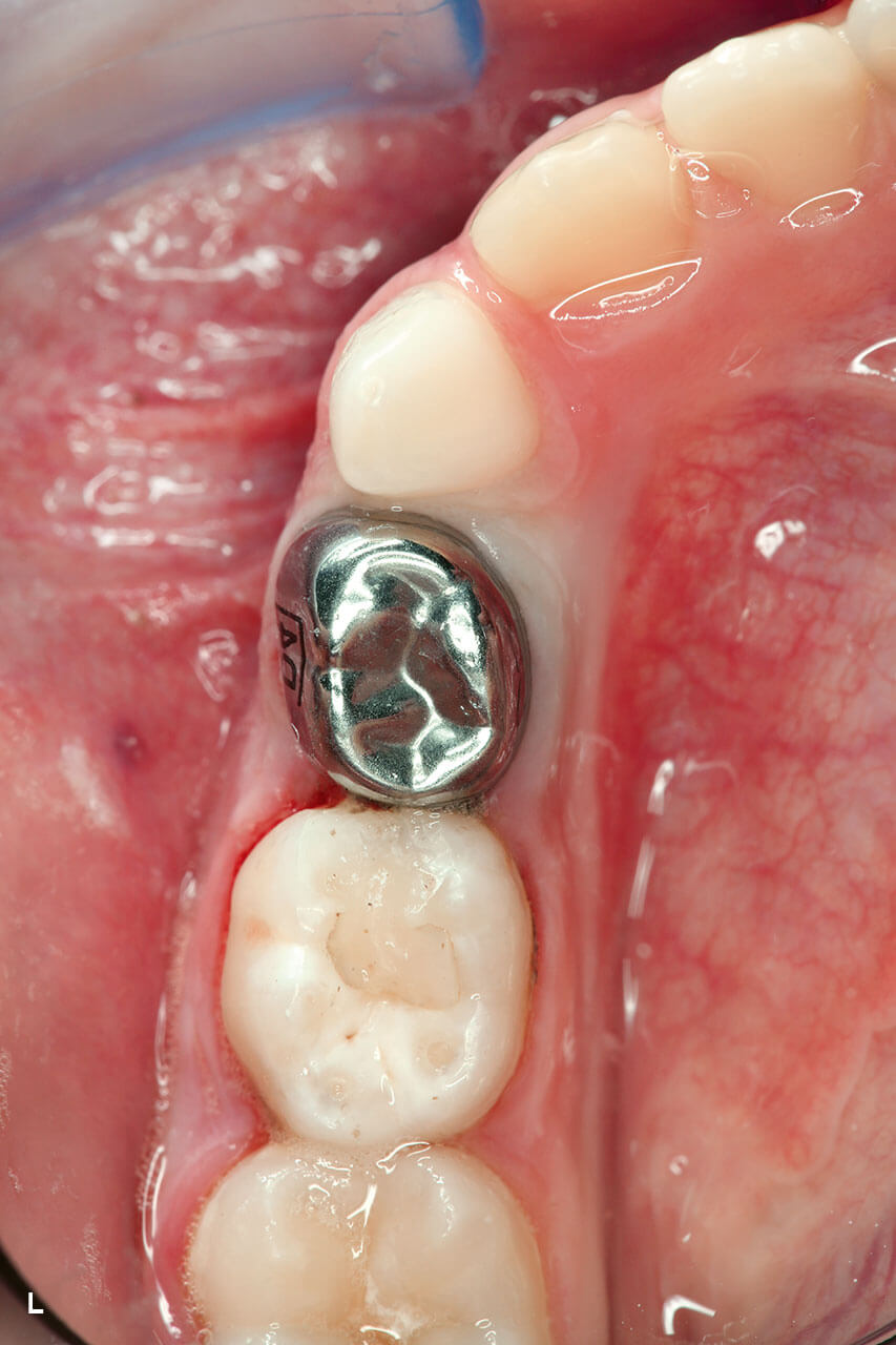 Abb. 3l Versorgung des Zahns mit einer Stahlkrone. 