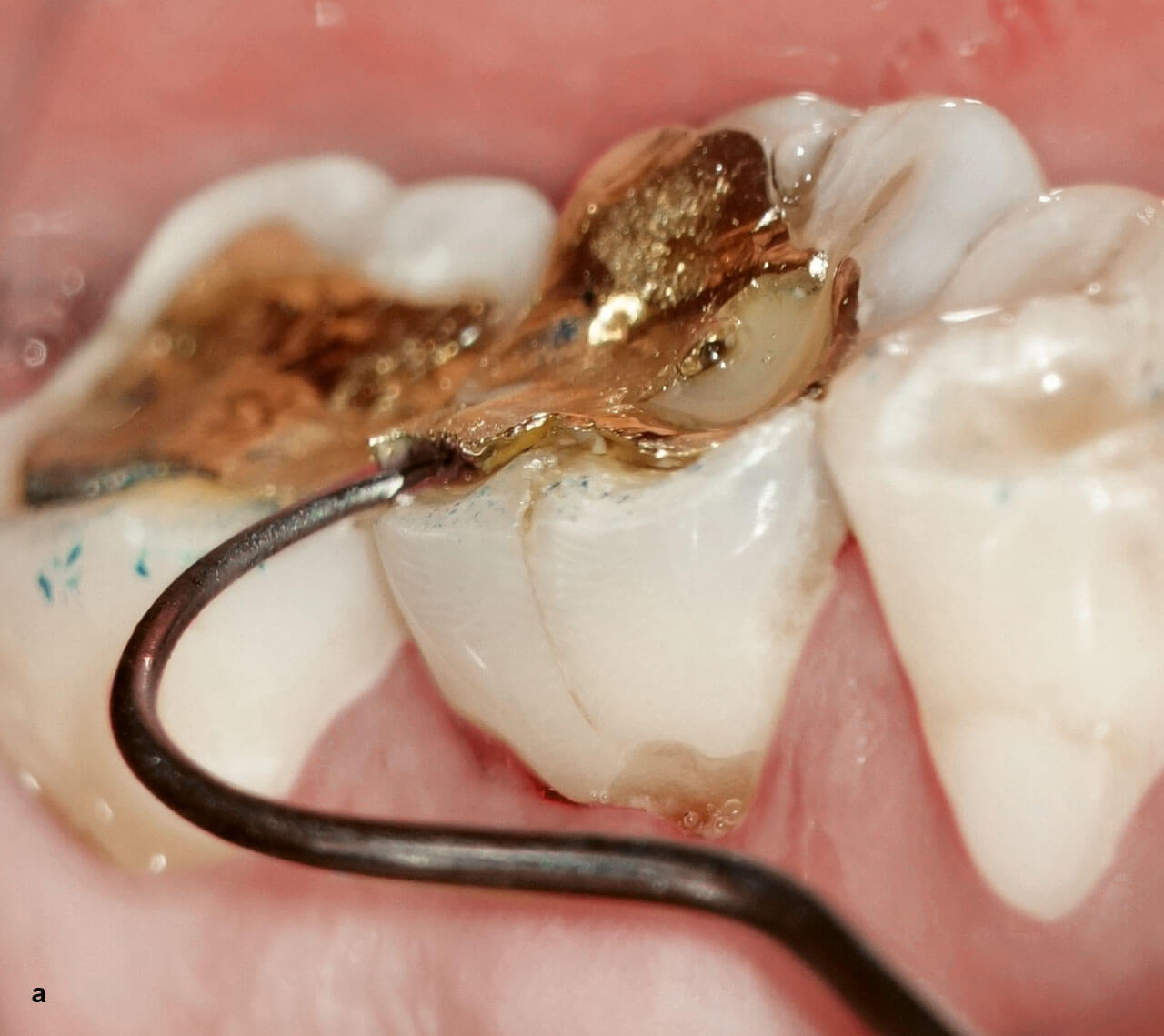 Abb. 1a und b Die vertikale Wurzelfraktur an Zahn 36 war unter einem Goldinlay verborgen.