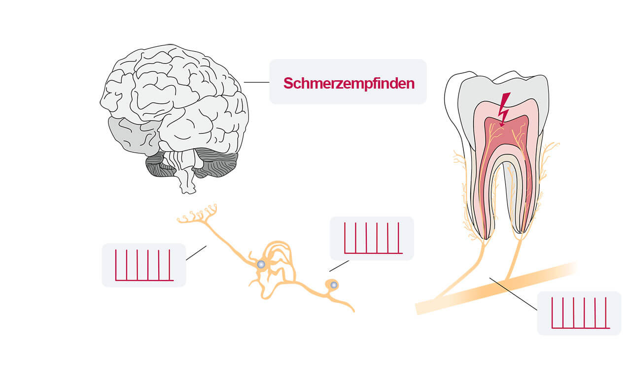 Abb. 7 und 8 Unterschied zwischen nozizeptiven (Abb. 7) und neuropathischen Zahnschmerzen (Abb. 8). Bei dentogenen Zahnmerzen entsteht der Zahnschmerz an den Schmerzrezeptoren in der Peripherie, bei neuropathischen Schmerzen bei Läsionen und Erkrankungen im Nervensystem.