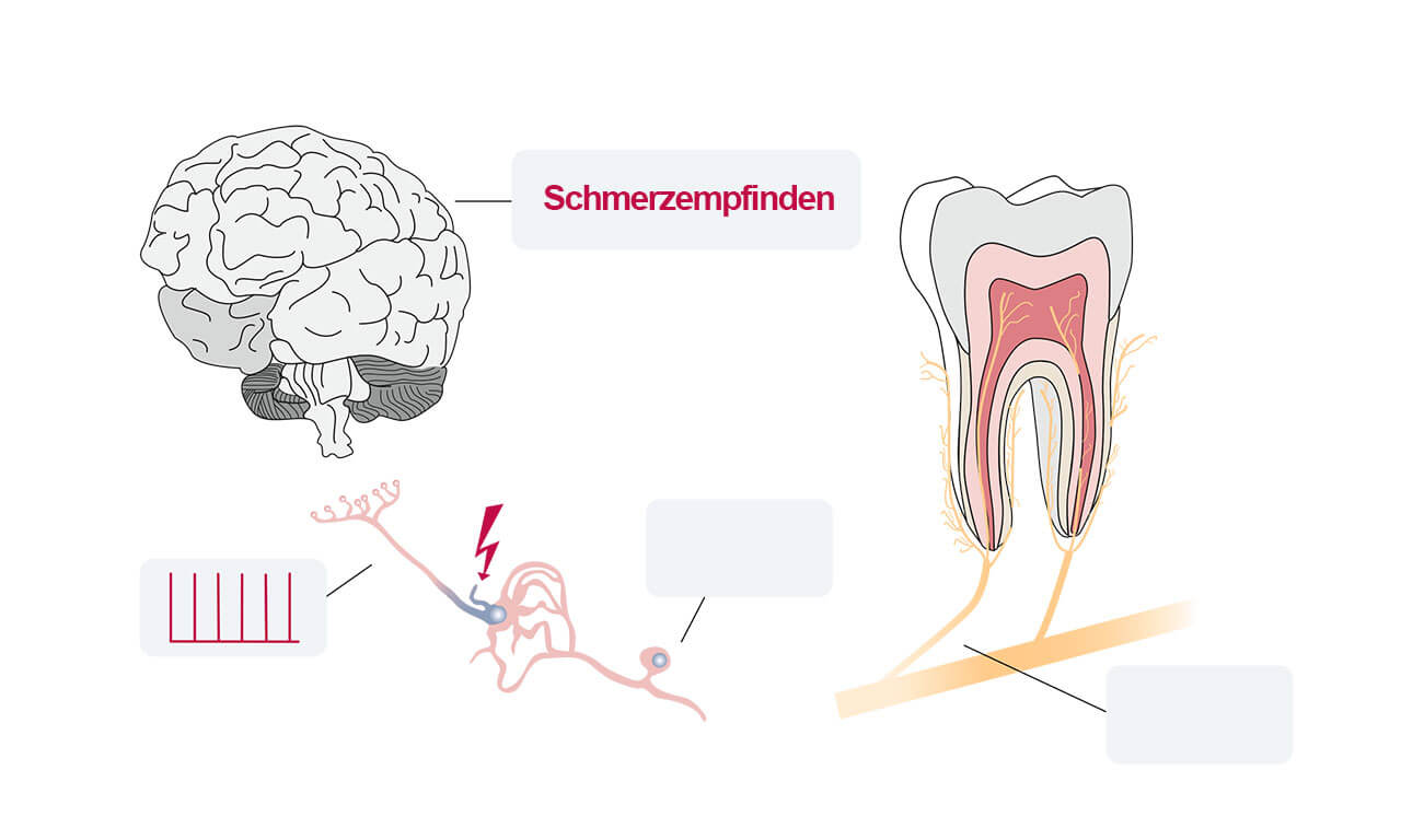Abb. 7 und 8 Unterschied zwischen nozizeptiven (Abb. 7) und neuropathischen Zahnschmerzen (Abb. 8). Bei dentogenen Zahnmerzen entsteht der Zahnschmerz an den Schmerzrezeptoren in der Peripherie, bei neuropathischen Schmerzen bei Läsionen und Erkrankungen im Nervensystem.