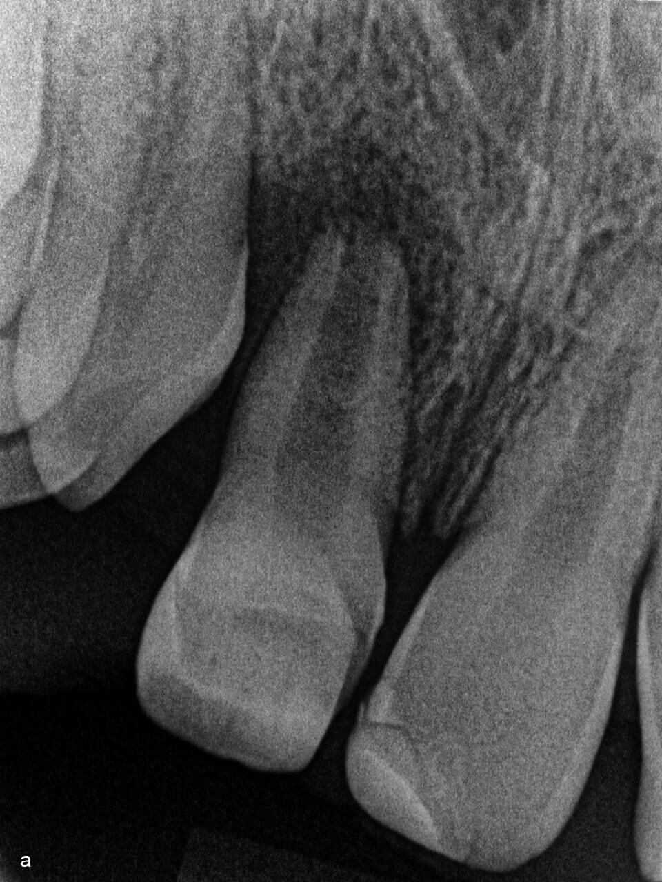 Abb. 2a Die zum Behandlungszeitpunkt 12-jährige Patientin erlitt im Alter von 8 Jahren ein Frontzahntrauma. Etwa 1 Jahr nach dem Unfallereignis wurden an dem verunfallten Zahn 11 eine Avitalität und ausgedehnte apikale Parodontitis diagnostiziert.
