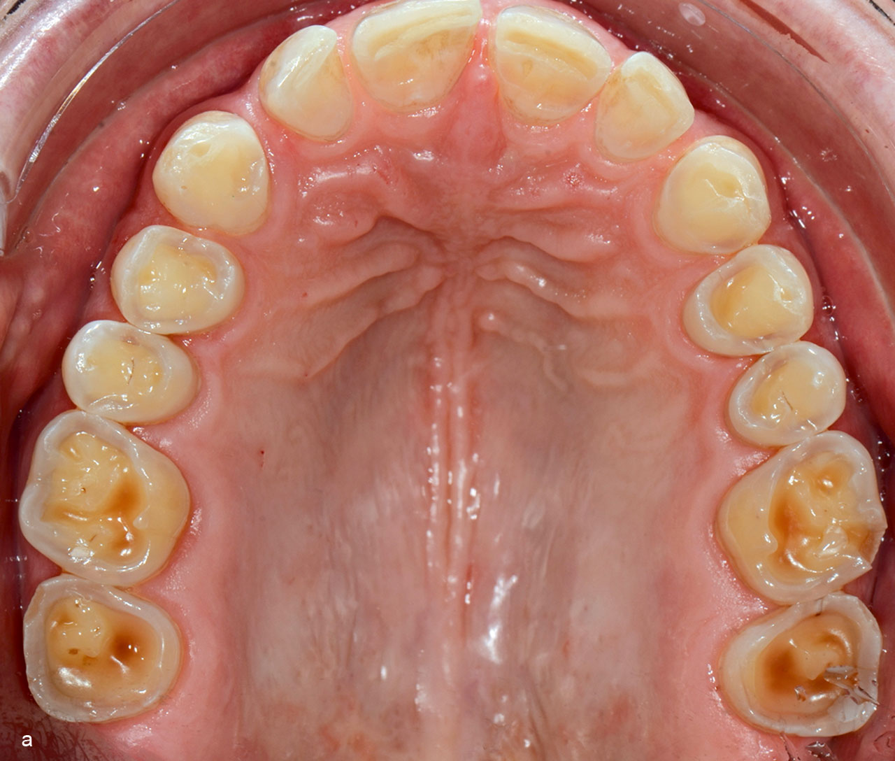 Abb. 1 a bis c Gebiss mit starkem erosiven Zahnhart­substanzverlust. Besonders auffällig – und abgrenzend zu einem durch Attrition verursachten Zahnhartsubstanz­verlust – sind die muldenförmigen Vertiefungen mit zum Teil „ausgefransten“ Rändern.