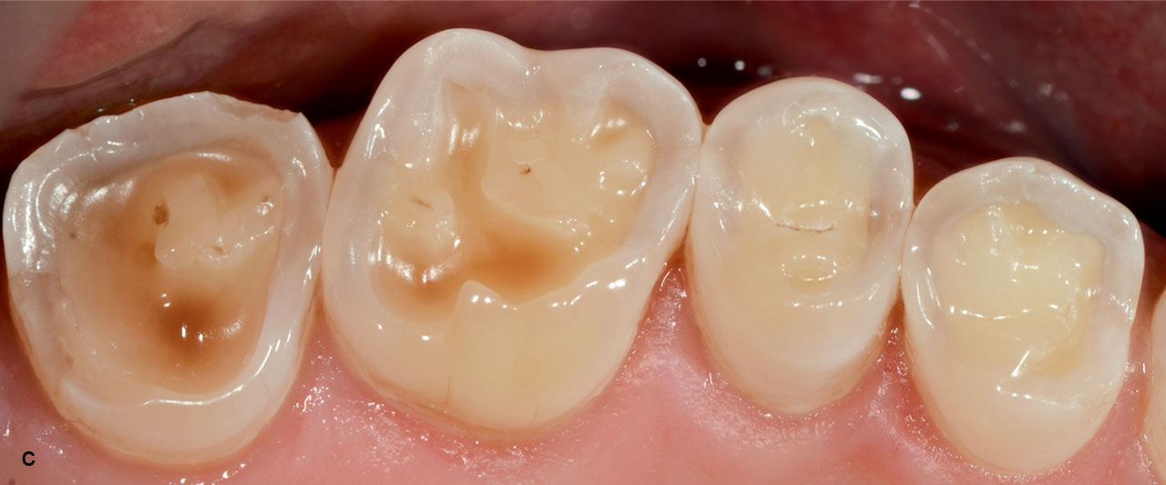 Abb. 1 a bis c Gebiss mit starkem erosiven Zahnhart­substanzverlust. Besonders auffällig – und abgrenzend zu einem durch Attrition verursachten Zahnhartsubstanz­verlust – sind die muldenförmigen Vertiefungen mit zum Teil „ausgefransten“ Rändern.