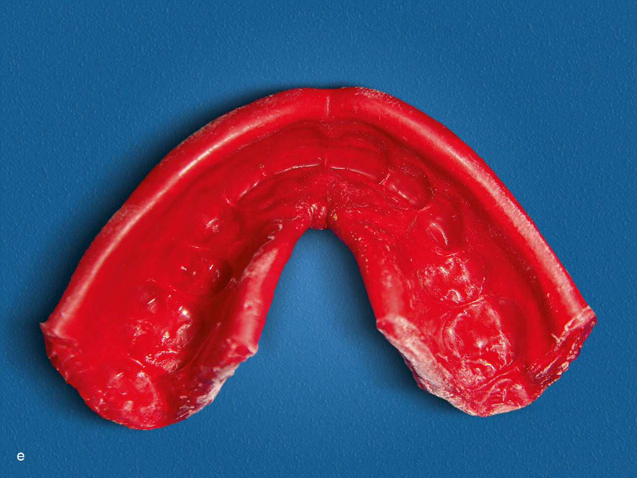 Abb. 1a bis f Aus unterschiedlichen Gründen unbrauchbarer und inakzeptabler Zahnschutz beim Sport.
