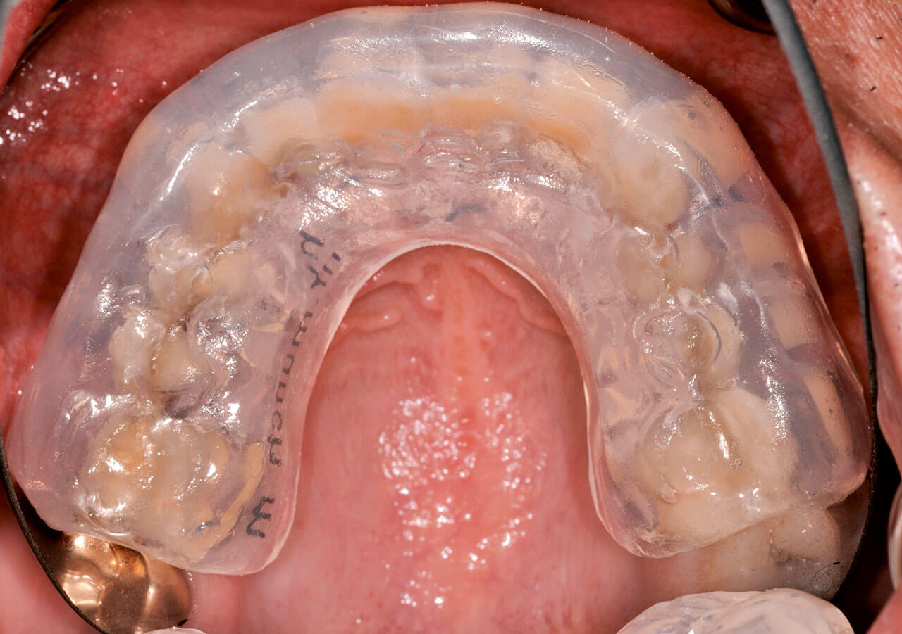 Abb. 10 Ein professioneller Zahnschutz fasst die ersten Molaren vollständig, die zweiten nie.