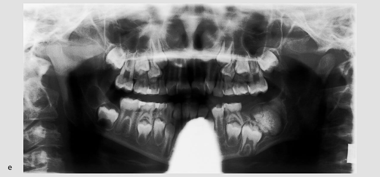 Abb. 1  Durchbruchsstörung des Zahns 36 durch ein komplexes Odontom in der Röntgendarstellung (e).