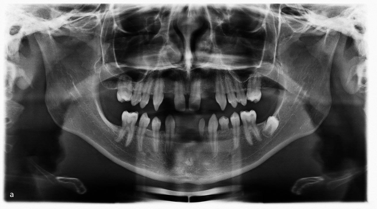 Abb. 3a  Auch bei distal angulierten Prämolaren ist ein spontaner Durchbruch mit Korrektur der Achsneigung des betroffenen Zahns möglich.