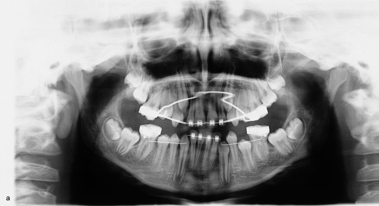 Abb. 4a  Durchbruchsstörung der zweiten Molaren nach Platzbeschaffung für den Durchbruch der Zähne in der Stützzone durch Distalkippung der ersten Molaren. 