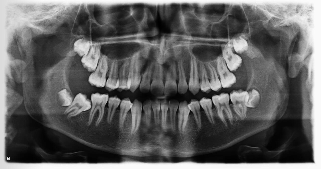 Abb. 5a bis i Retention eines zweiten unteren Molaren unter dem ersten Molaren. Die Mesialkippung und ein geringer Abstand vom ersten Molaren zum Ramusrand sind in der Röntgendiagnostik gut ersichtlich. 