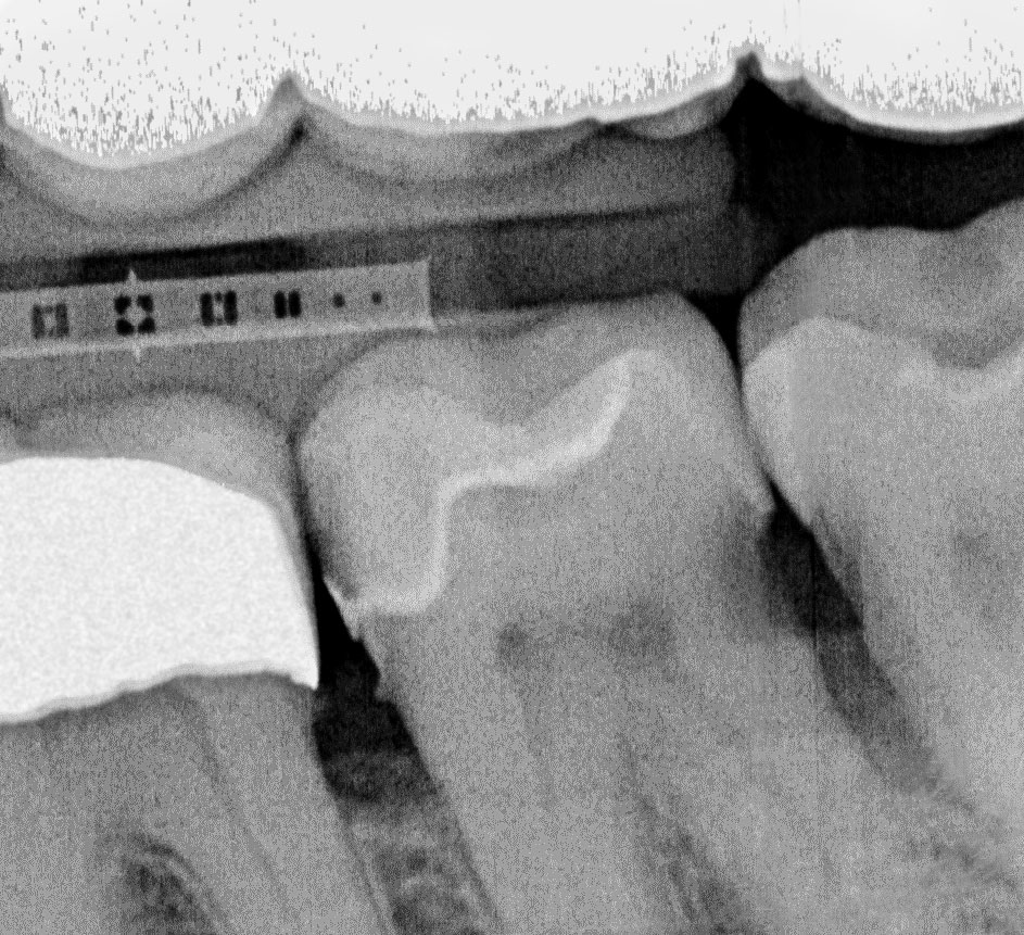 Abb. 1 Präoperativer standardisierter Röntgenzahnfilm Regio 37/38. Sichtbar ist eine Transluzenz an Zahn 37 distal im Sinne einer C3-Karies und okklusal im Sinne einer Unterfüllung. An Zahn 37 mesial und Zahn 36 distal zeigen sich Opazitäten im Sinne von Konkrementen.