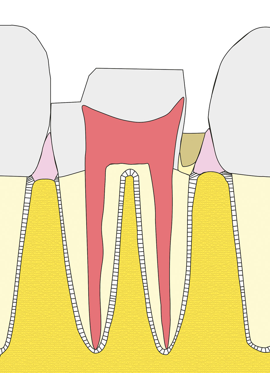 Abb. 8b Zahn 37 – ­schematische Darstellung der Kastenelevation mittels Komposit und der Aus­arbeitung.