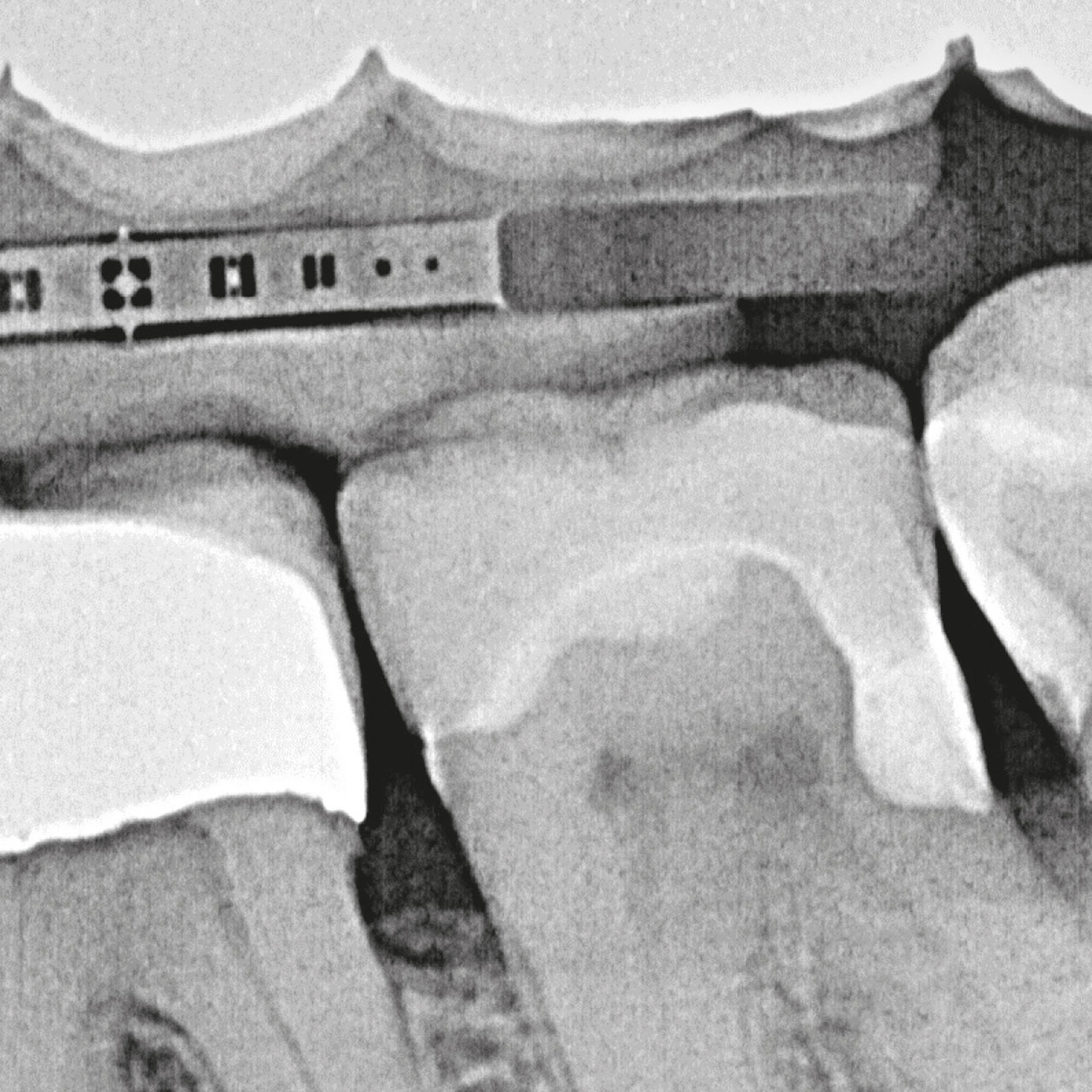 Abb. 17a Postoperativer standardisierter Röntgenzahnfilm Regio 37/38. Sichtbar sind eine Opazität an den Zähnen 37 und 38 im Sinne einer randständigen homogenen Füllung und eine Opazität an Zahn 37 in Sinne eines Overlays.