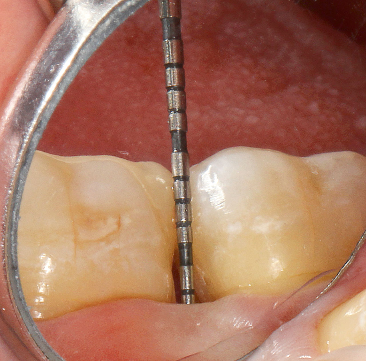 Abb. 19 Klinische Ansicht des Zahnes 37 von bukkal nach 3 Monaten. Die Sondierungstiefen lagen zwischen 2 und 3 mm.
