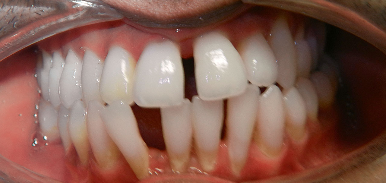 Abb. 2b ... und klinischer Okklusionsbefund eines 40-jährigen Patienten (O1max.mand.-Typ – divergierende Kieferbasen) mit unzureichender Mundhygiene, eingeengtem Zungenraum, Kreuz- und Kopfbiss sowie zahlreichen gingivalen Rezessionen, insbesondere an Zahn 42. Die sich rasant verstärkende Zahnlockerung mit Stellungsänderung war Anlass zur Beratung beim Mund-, Kiefer- und Gesichtschirurgen, nachdem alio loco die Empfehlung zu einer chirurgisch unterstützten Gaumennahterweiterung (SARME) gegeben worden war.