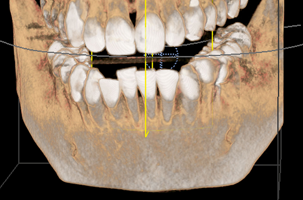 Abb. 3c ... und dreidimensionale DVT-Oberflächenrekonstruktion eines Patienten (N1-Kasus, Grenze zu O1mand) zu Beginn des fünften Lebensjahrzehnts mit dentaler Kompensation (1-NB: 8,9 mm, 32,9°) einer skelettalen Klasse II ohne harmonisches Alignment der unteren Inzisivi zur apikalen Basis. Es zeigt sich eine zunehmende Lockerung der Zähne 41 und 42 durch die bukkal nahezu völlig frei liegenden Zahnwurzeln ohne bukkale Knochenlamelle nach langjährigem Versuch, mit einer Klasse-II-Mechanik eine neutrale Bisslage zu erreichen.
